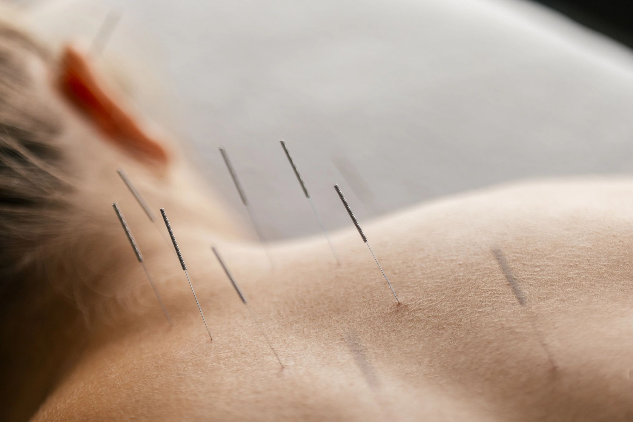 Patient receiving acupuncture treatment in a calm clinic setting
