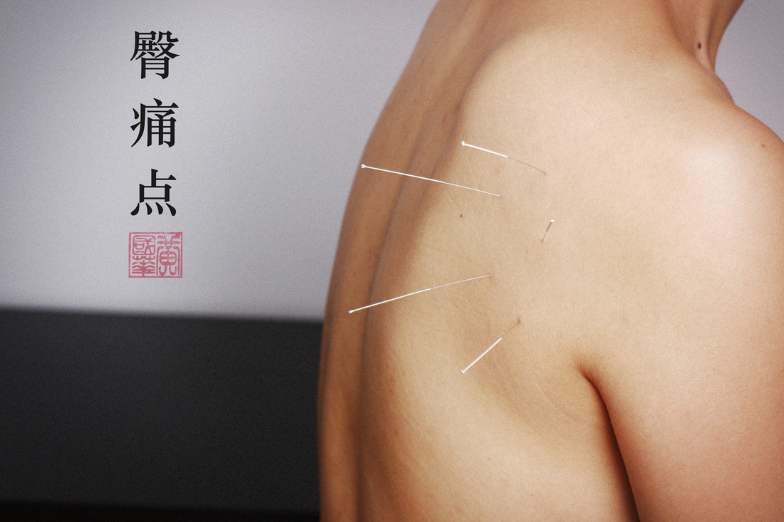 Combined acupuncture and herbal treatment