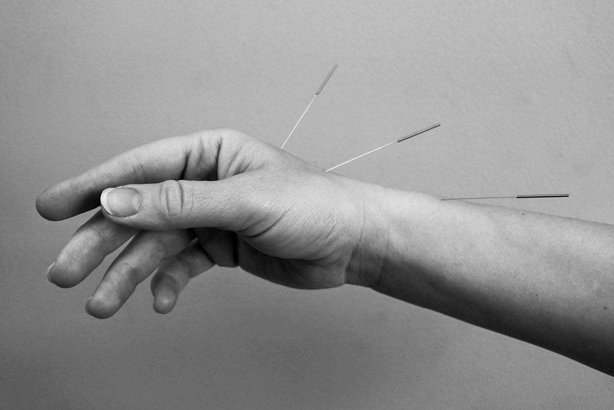 Black and white photo of acupuncture needles on a patient's hand — distal needling technique, Nature's Chinese Medicine Perth