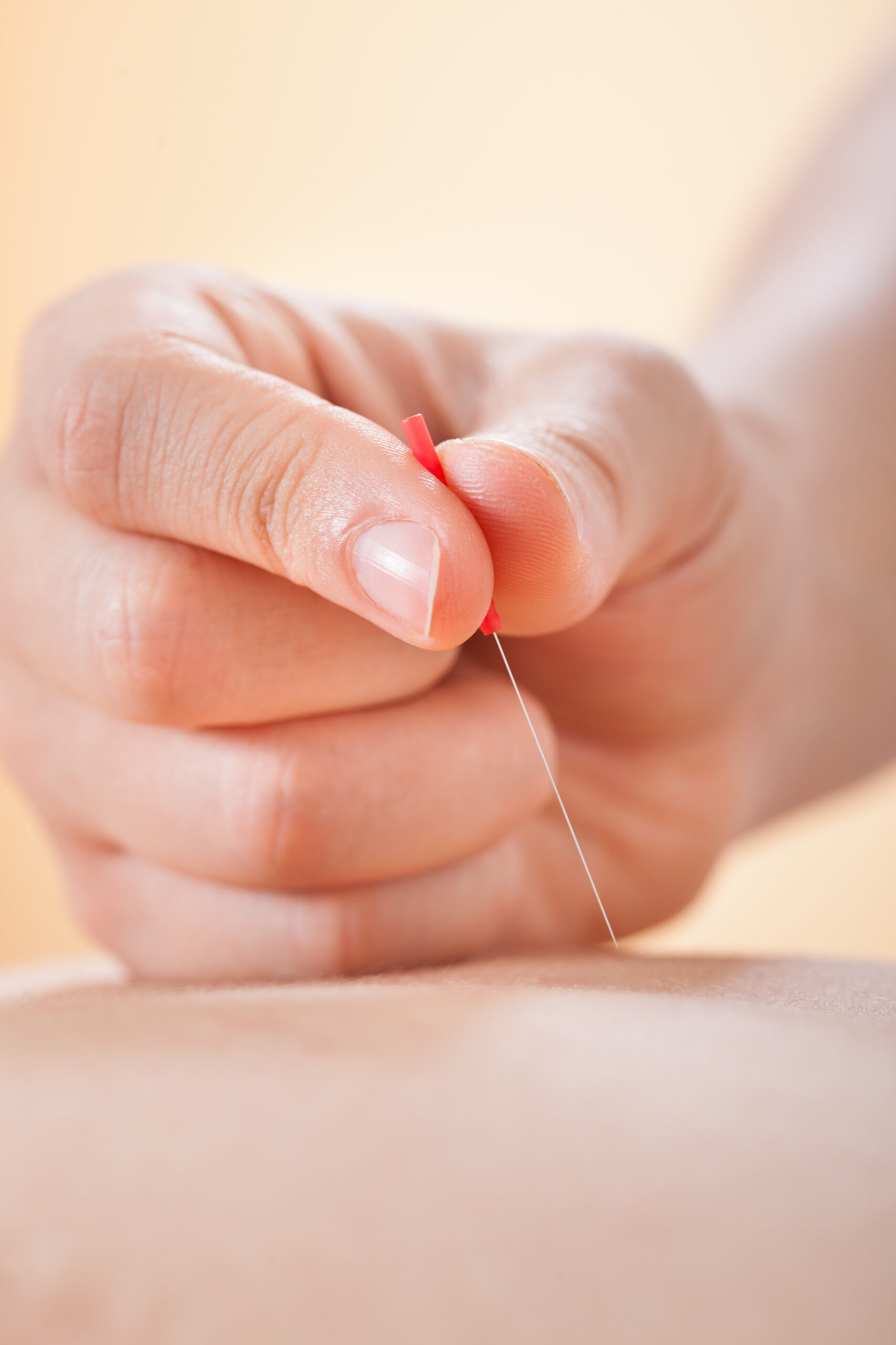 Patient relaxing during acupuncture treatment