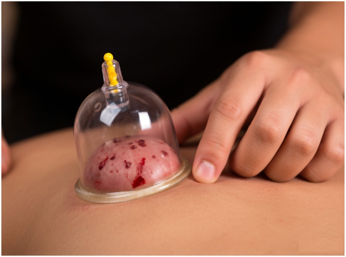 Wet Cupping(blood cupping) treatment at Nature's Chinese Medicine clinic — therapeutic cupping cup drawing out stagnant blood