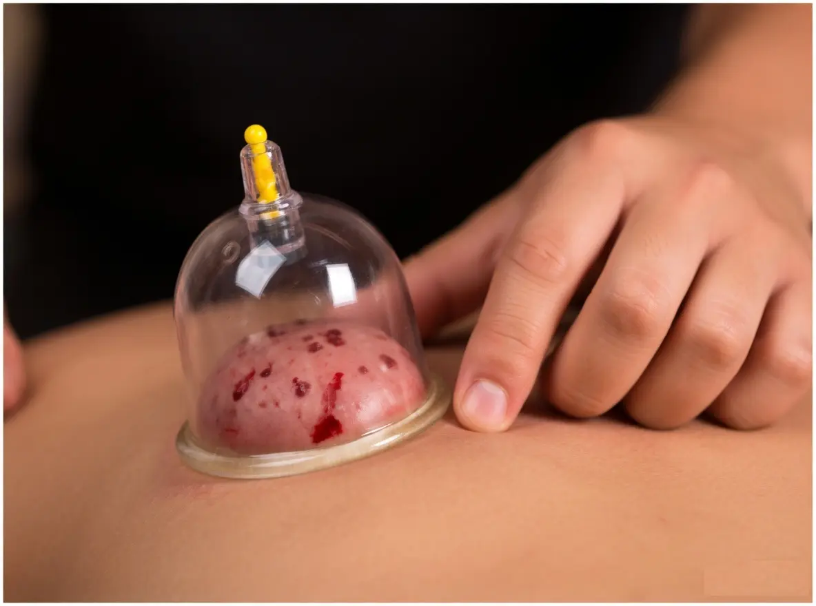 Wet Cupping(blood cupping) treatment at Nature's Chinese Medicine clinic — therapeutic cupping cup drawing out congested blood