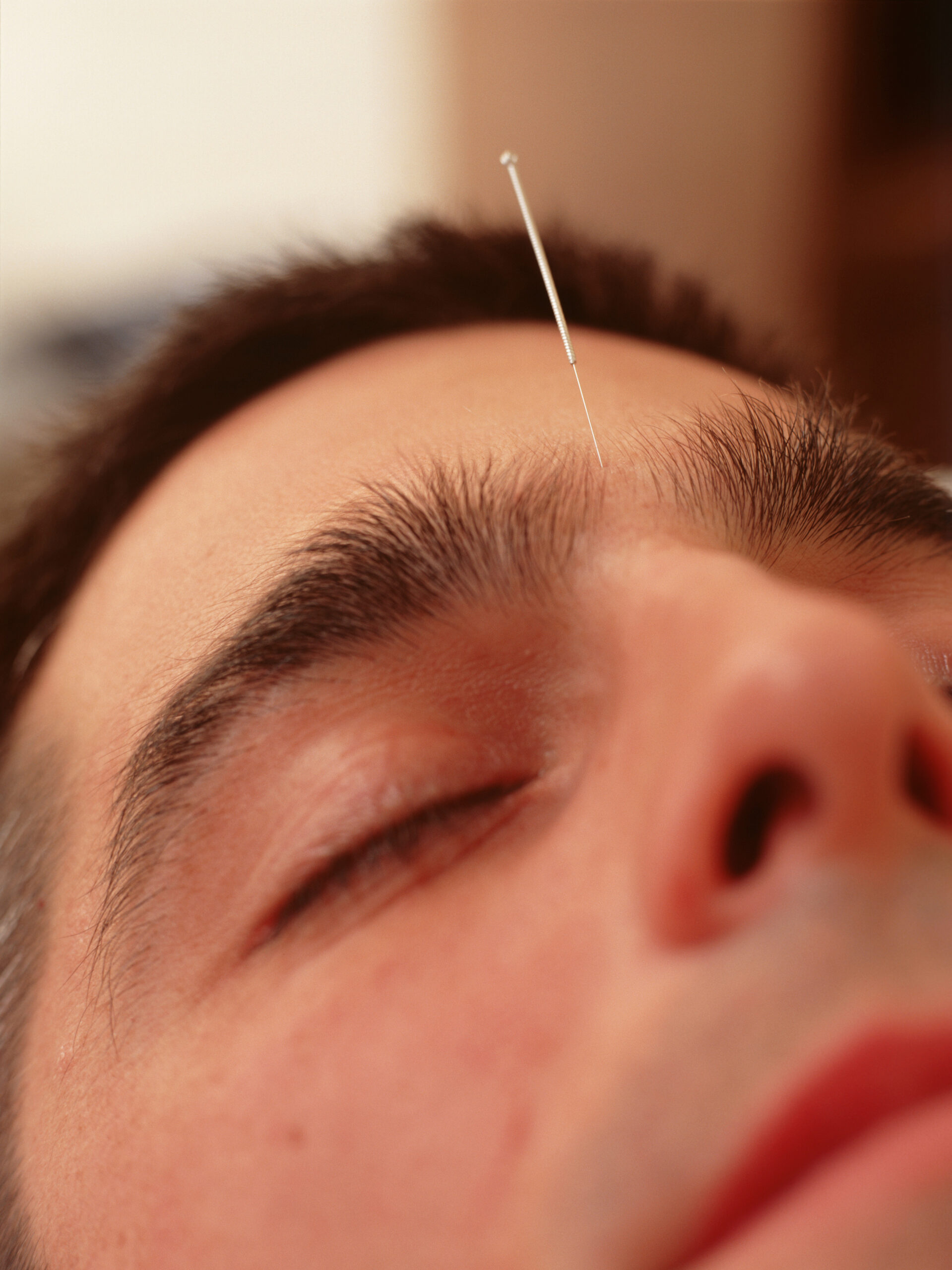 Patient resting during acupuncture treatment