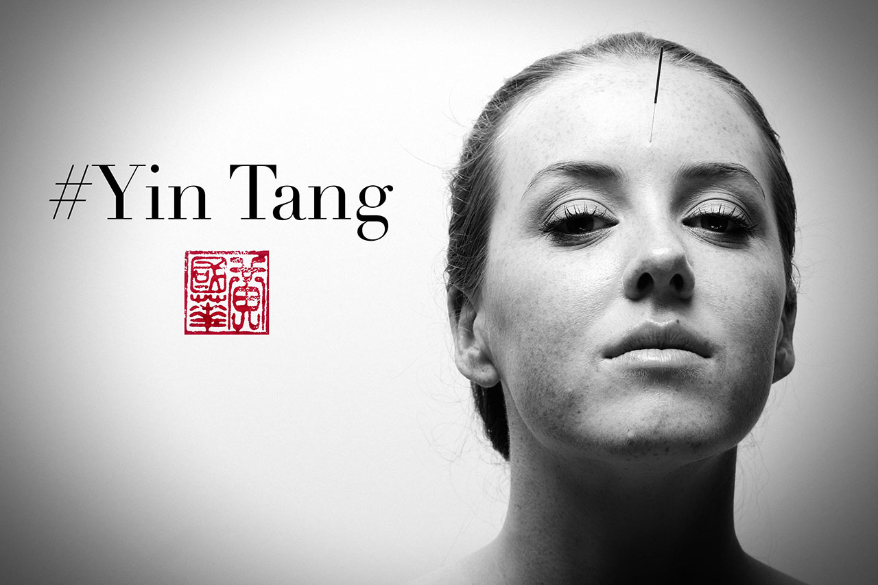 Black and white portrait of acupuncture needle at the Yin Tang point on a patient's forehead — Nature's Chinese Medicine Perth