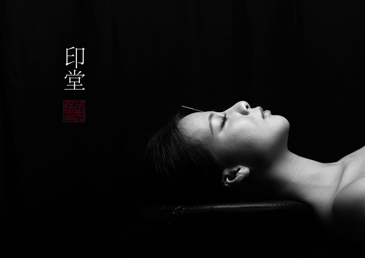 Black and white close-up of acupuncture needle at the Yin Tang point between the eyebrows — Nature's Chinese Medicine, Perth